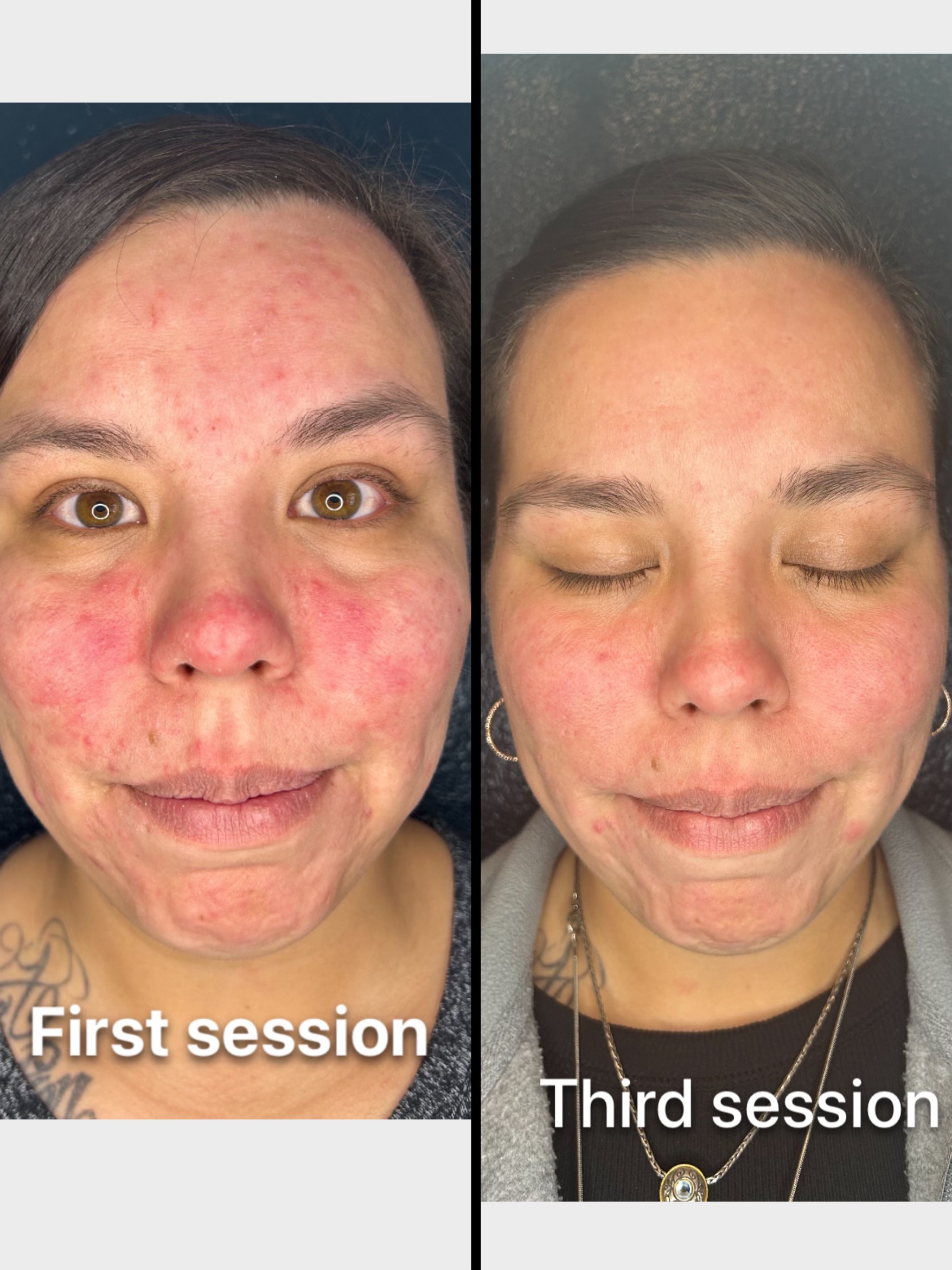 Microneedling Acne Treatment near Me