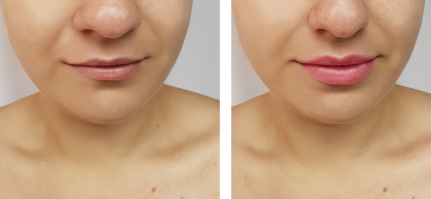 Affordable Lip Filler Greeley