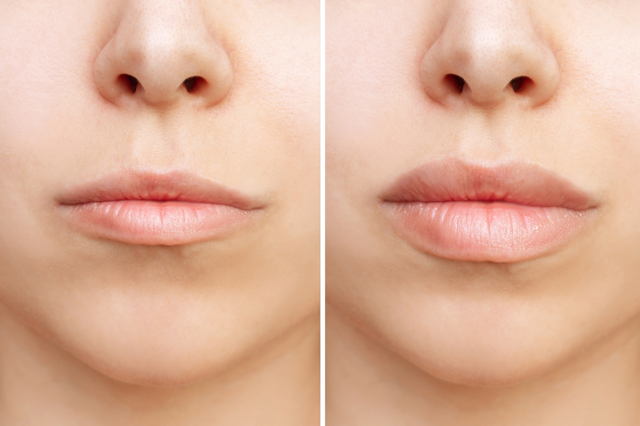 Lip Filler Before and After
