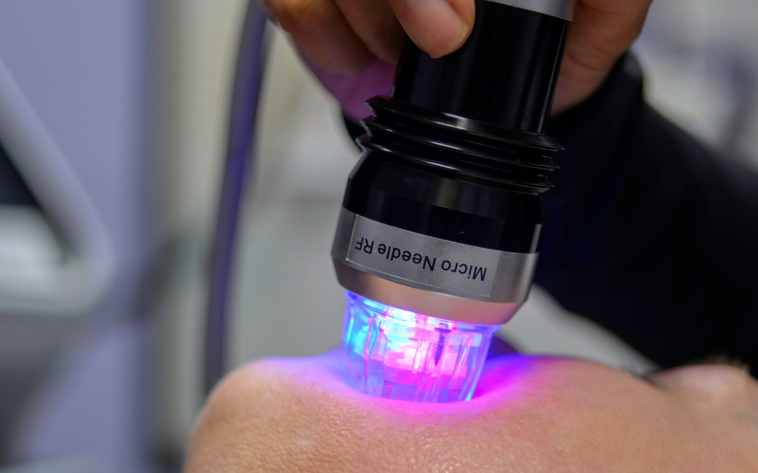 Microneedling Near Me