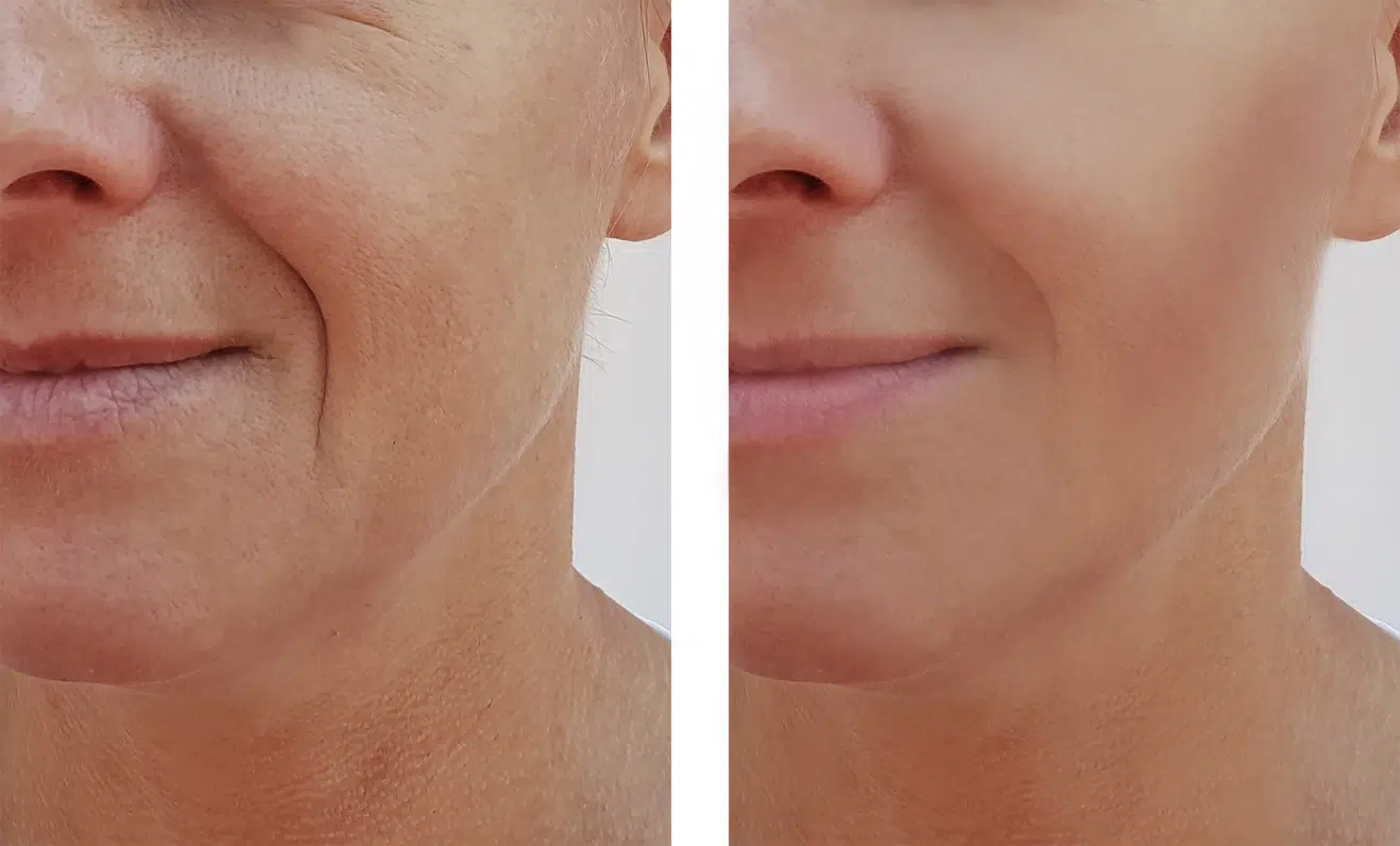 Marionette Lines Filler Near Me