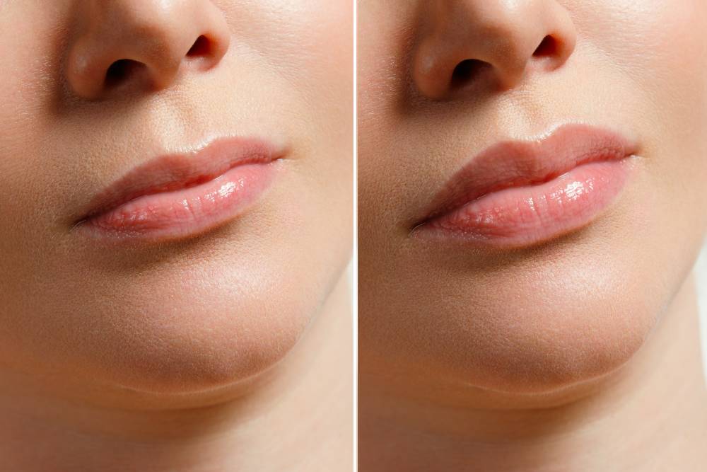 lip fillers fort collins