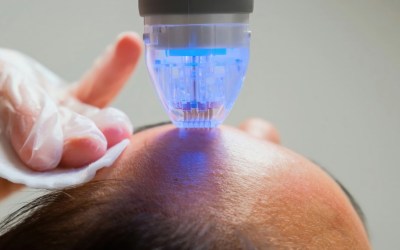 What is Microneedling and Does It Work?