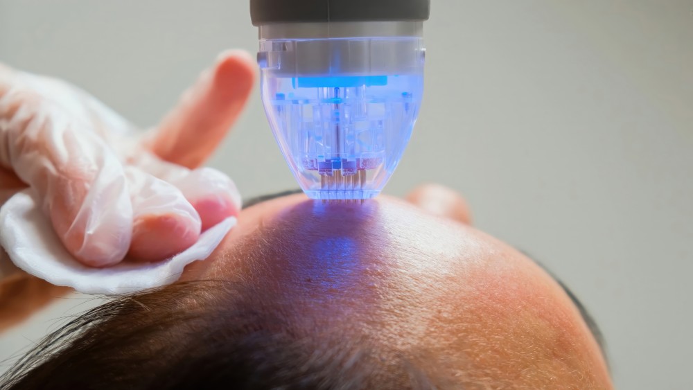 What is Microneedling and Does It Work?