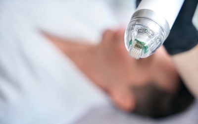 RF Microneedling vs Microneedling: What’s the Difference?