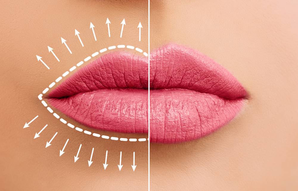 Best Lip Fillers in Northern Colorado | Provider Guide